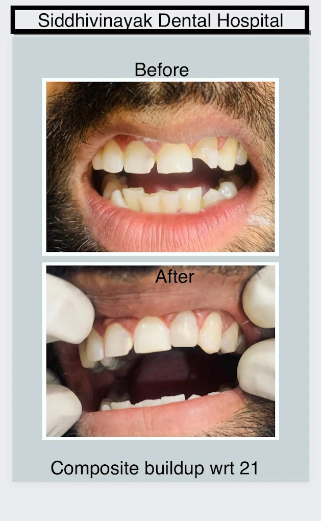 Before and after composite buildup dental treatment